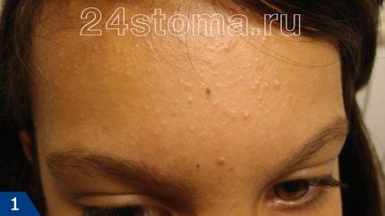Loțiune și gel delex acnee - recenzii de cosmeticieni, instrucțiuni, preț