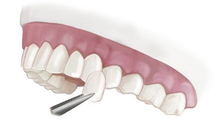 Люмініри - ціни, фото до і після, відмінності голлівудських вінірів - стоматологічний портал