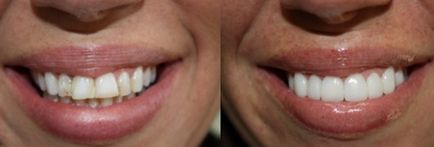 Lumineers - prețuri, fotografii înainte și după, diferențe de furnir hollywood - portal dentar