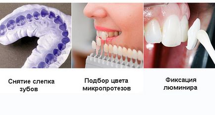 Lumineers - prețuri, fotografii înainte și după, diferențe de furnir hollywood - portal dentar