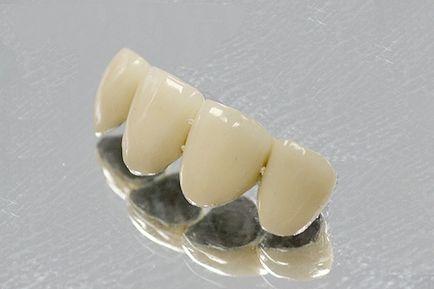 Proteze ceramice metalice ale dinților, coroanelor, podurilor la prețuri avantajoase