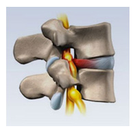 Hernia intervertebrală