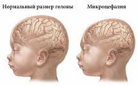 Мікроцефалія - ​​причини, симптоми, діагностика та лікування