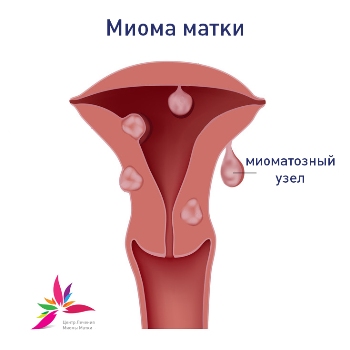 Miroza uterului atunci când este posibil să se facă fără o operație