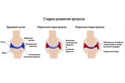 Чи можна гріти суглоби при артрозі особливості хвороби та користь від теплового впливу