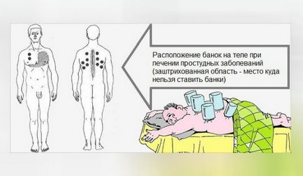 Este posibil să se pună cutii în pneumonie (pneumonie)