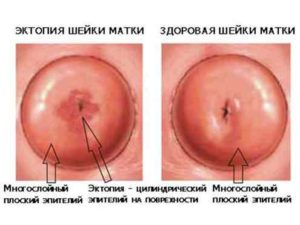 Este posibil să rămâneți însărcinată cu eroziunea cervicală a uterului prin influența diferitelor tipuri de boli asupra concepției