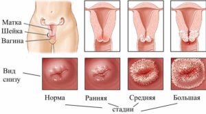Este posibil să rămâneți însărcinată cu eroziunea cervicală a uterului prin influența diferitelor tipuri de boli asupra concepției