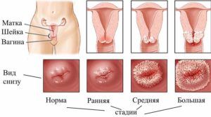 Чи можна завагітніти при ерозії шийки матки вплив різних видів хвороби на зачаття