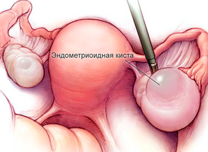 Чи можна завагітніти з кістою яєчника, діагностика і видалення новоутворення