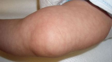 Pielea de marmură din copil este o boală sau o caracteristică