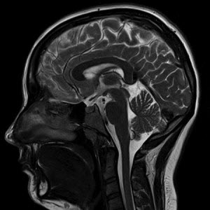Capul mert și vasele cerebrale