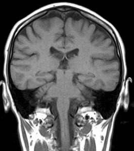 MRI a fej és agyi erek