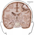 Невринома слухового нерва причини, симптоми, консервативне лікування, видалення і післяопераційний