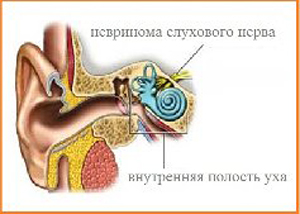 Невринома слухового нерва причини, симптоми, консервативне лікування, видалення і післяопераційний