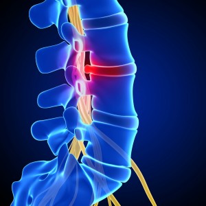 Modul de viață în osteochondroză - ce trebuie să ne amintim