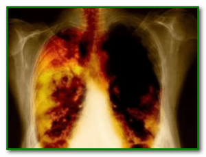 Очищення легенів після куріння в домашніх умовах