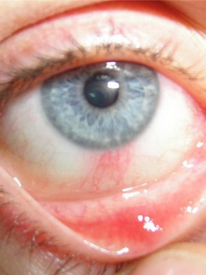 Oftmormorozacea fotografie și tratamentul ochilor rosacee, simptomele ochiului oftalmic