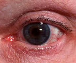Ophthalmoroscea - Cauze, Simptome, Diagnostic și Tratament