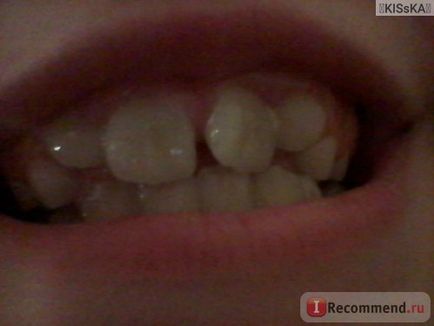 Plăci ortodontice pe dinți pentru a corecta mușcătura la copii