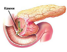 Pancreatită acută Descriere, cauze, simptome, tratament