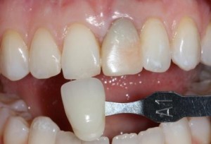 Відбілювання зубів zoom, стоматологія дантист