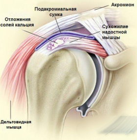 Відкладення солей в плечовому суглобі причини і лікування