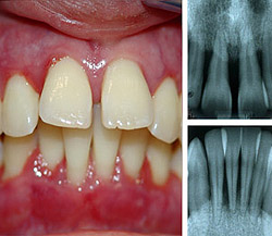 Periodontită - cauze, simptome, diagnostic și tratament