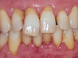 Periodontită - cauze, simptome, diagnostic și tratament