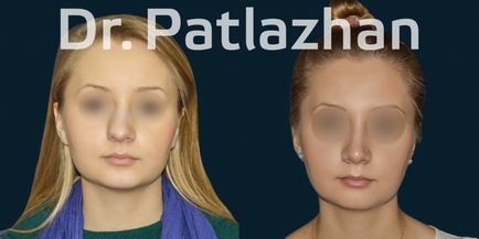 Plasztikai sebészet Kijevben, Odesszában, Dnyeper, plasztikai sebészet klinika Dr. Patlazhan g