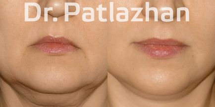 Chirurgie plastică la Kiev, Odessa, Dnipro, Clinica de Chirurgie Plastică Dr. Patlajan g