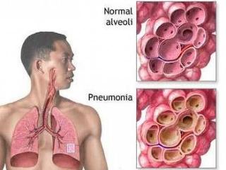 Cauzele pneumotoraxului, simptomele, tratamentul