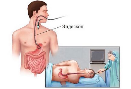 Prevenirea cancerului de stomac sau cum să vă asigurați împotriva tumorilor