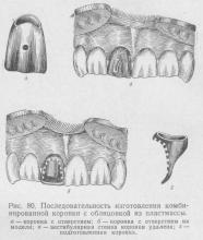 Протезування комбінованої коронкою, ортопедична стоматологія