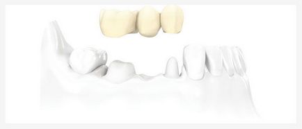 Протезування зубів в Йошкар-оле металокераміка, нейлонові протези, безметалловая кераміка
