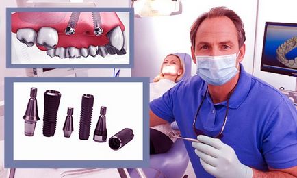 Ellenjavallatok telepíteni implantátumok fogak