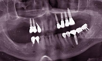 Протипоказання до установки імплантів на зуби