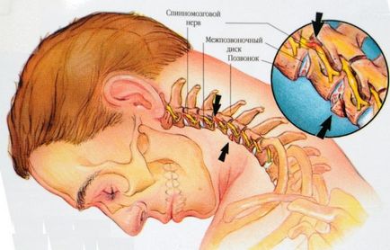 Radiculita (radiculopatia) simptomelor cervicale ale coloanei vertebrale și tratamentul la domiciliu, inclusiv