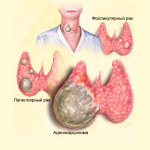 Рак щитовидки прогноз віжіваемості