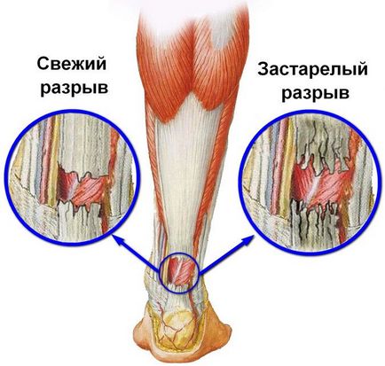 Ruptura simptomelor musculare gastrocnemius