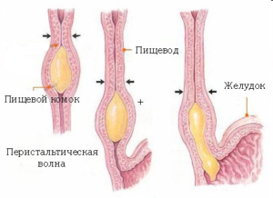 Ruptura esofagiană - sindromul Burkhawe Cauze și simptome