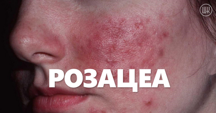 Rosacea pe față - ce este tratamentul cu rosacee