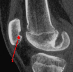 Rassekayuschy osteochondrită a articulației genunchiului, genunchi genunchi tratament boală, disecție