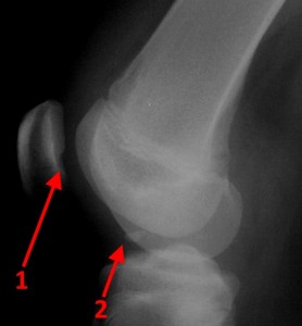 Rassekayuschy osteochondrită a articulației genunchiului, genunchi genunchi tratament boală, disecție