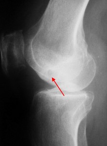 Rassekayuschy osteochondrită a articulației genunchiului, genunchi genunchi tratament boală, disecție