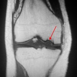 Rassekayuschy osteochondrită a articulației genunchiului, genunchi genunchi tratament boală, disecție