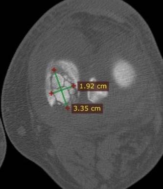 Rassekayuschy osteochondrită a articulației genunchiului, genunchi genunchi tratament boală, disecție