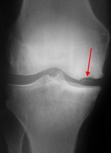 Ррассекающій остеохондрит колінного суглоба, хвороба Кеніга колінного суглоба лікування, розтинає