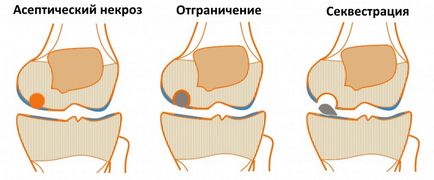 Rassekayuschy osteochondrită a articulației genunchiului, genunchi genunchi tratament boală, disecție