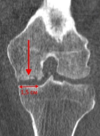 Rassekayuschy osteochondrită a articulației genunchiului, genunchi genunchi tratament boală, disecție